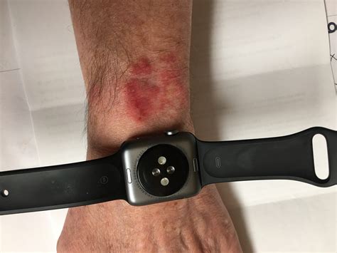 apple watch big wrist|rash from wearing apple watch.